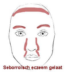 eczeem in het gezicht seborroisch