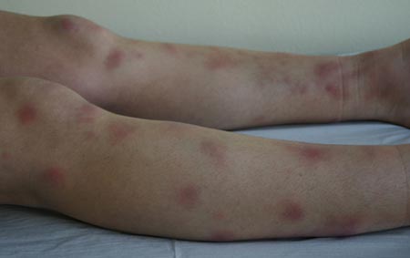 erythema nodosum