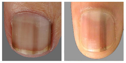 melanonychia pigment streep nagel