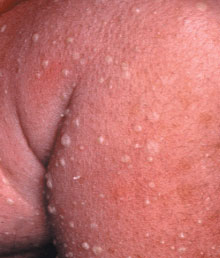 neonatale pustuleuze dermatose