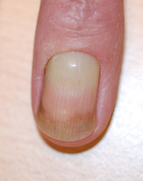 gele nagel syndroom