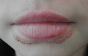 liplik eczeem lip lick dermatitis