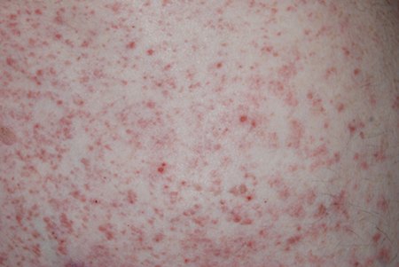 ziekte van Grover transiente acantholytische dermatose