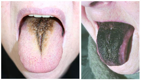 haartong black hairy tongue