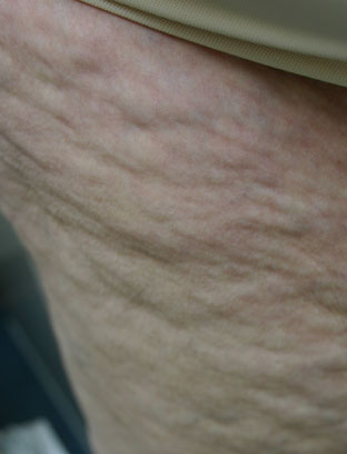 sinaasappelhuid cellulite 