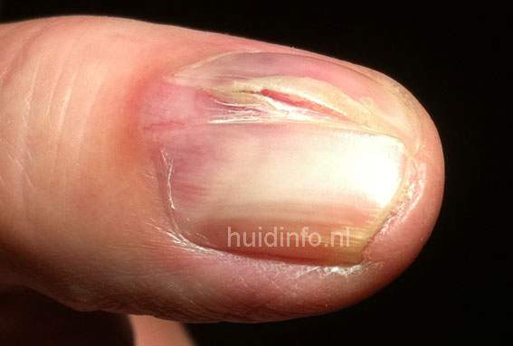 glomus tumor nagel