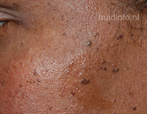 dermatosis papulosa nigra