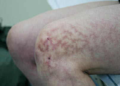 erythema ab igne warmte huid litteken