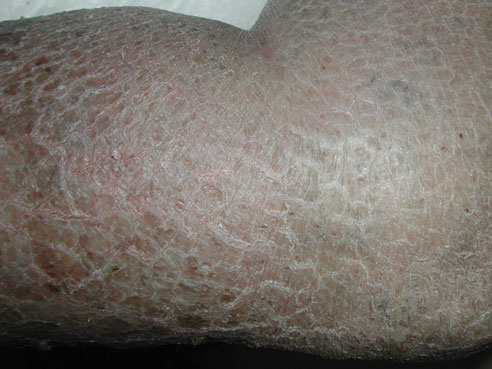ichthyosis vulgaris schilfering droge huid