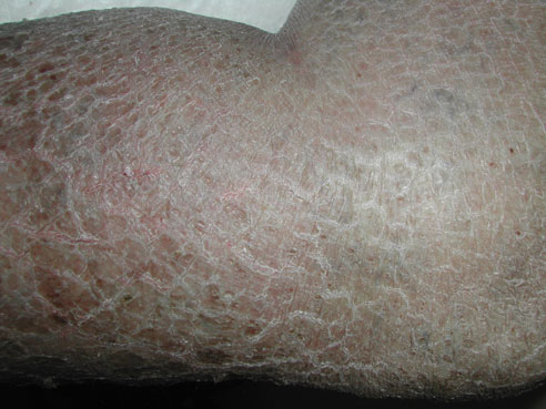 Grondwet goochelaar De neiging hebben Ichthyosis – Da Vinci Clinic