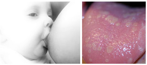 spruw candida