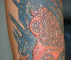 tattoo tatoeage pigment laser