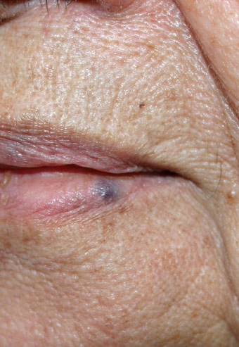 venous lake hemangioom lip